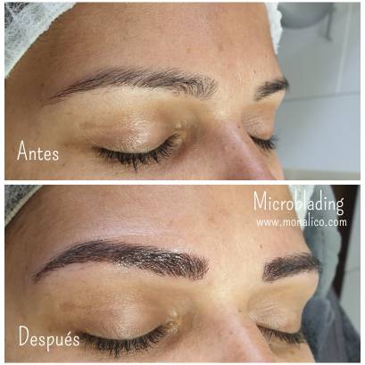 Cejas despobladas tratamiento en Monalico