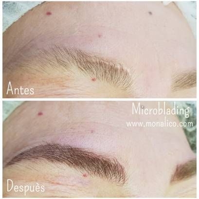 Cejas despobladas tratamiento